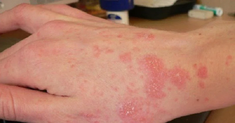 Bệnh Histoplasmosis: Nhiễm Nấm Histoplasma Nguy Hiểm Nhưng Thầm Lặng 7 Nhiễm nấm Histoplasmosis ở phổi