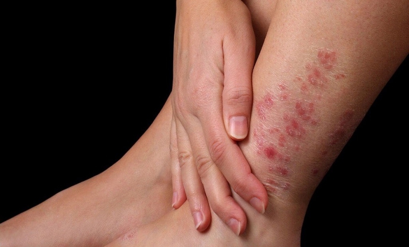 Bệnh Histoplasmosis: Nhiễm Nấm Histoplasma Nguy Hiểm Nhưng Thầm Lặng 8 Hình ảnh xét nghiệm Histoplasma