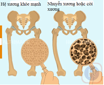 triệu chứng còi xương ở trẻ