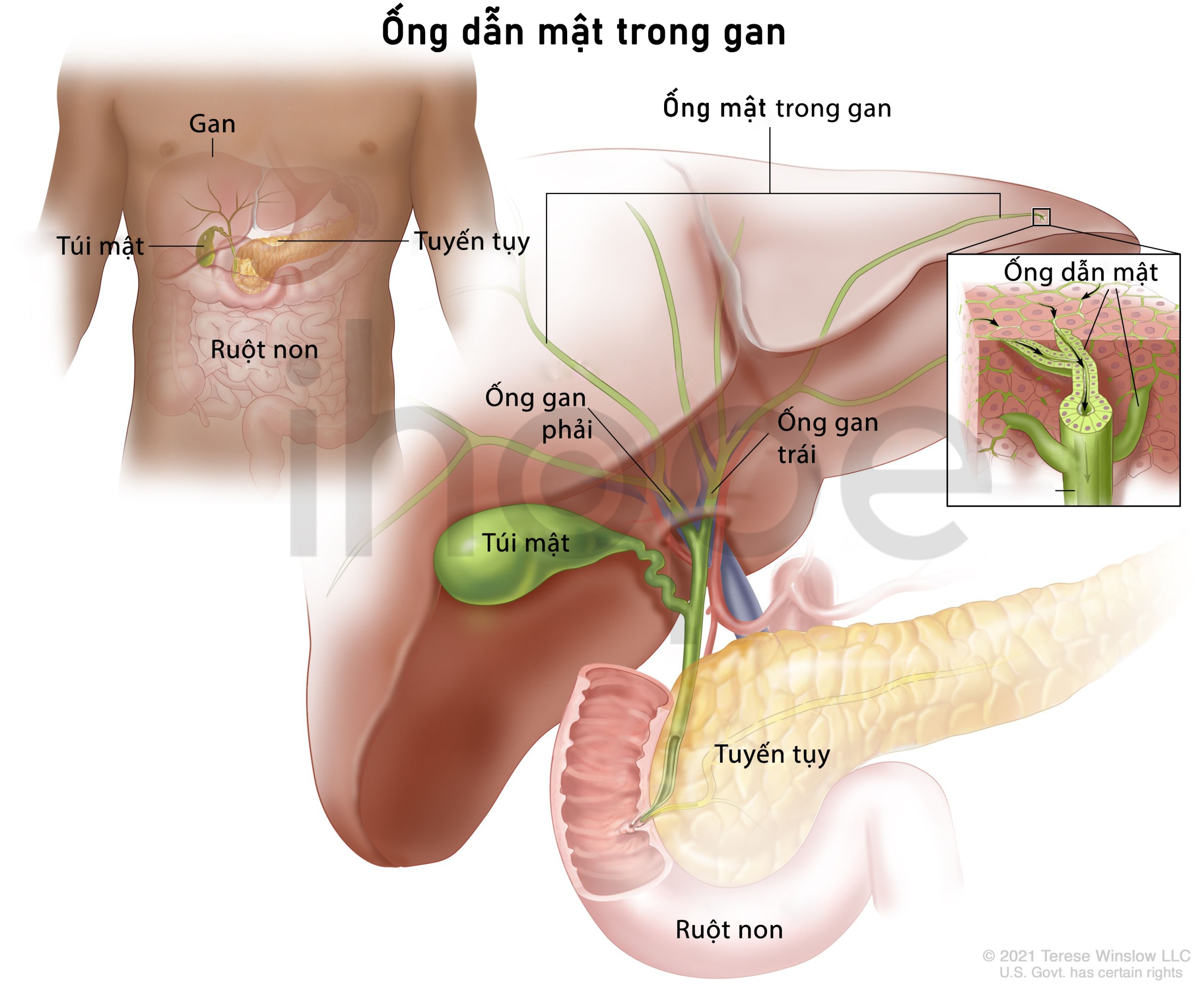 Ống dẫn mật bị tắc nghẽn trong thai kỳ