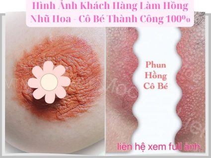 Làm Hồng Nhũ Hoa và Vùng Kín: Các Phương Pháp Hiệu Quả, An Toàn Nhất Hiện Nay 6 Peel da làm hồng vùng kín