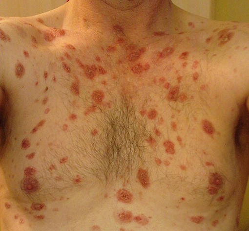 Hình ảnh Pemphigus vảy lá