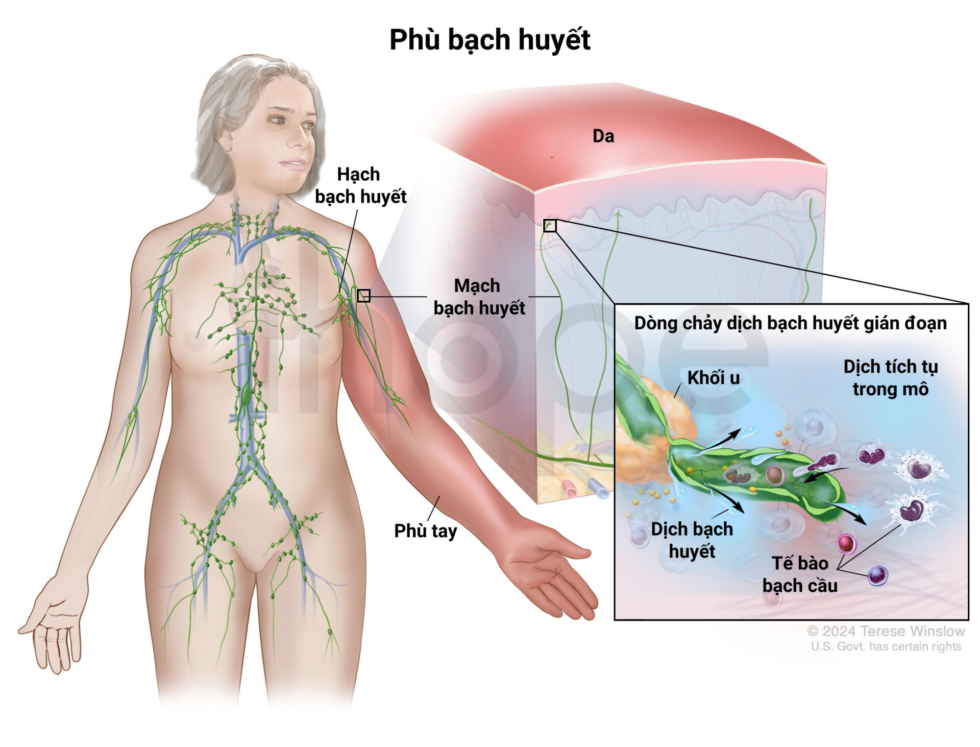 Hình ảnh bệnh nhân có biểu hiện tràn dịch bạch huyết