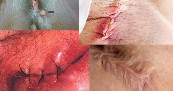 Nhiễm trùng vết khâu tầng sinh môn sau sinh