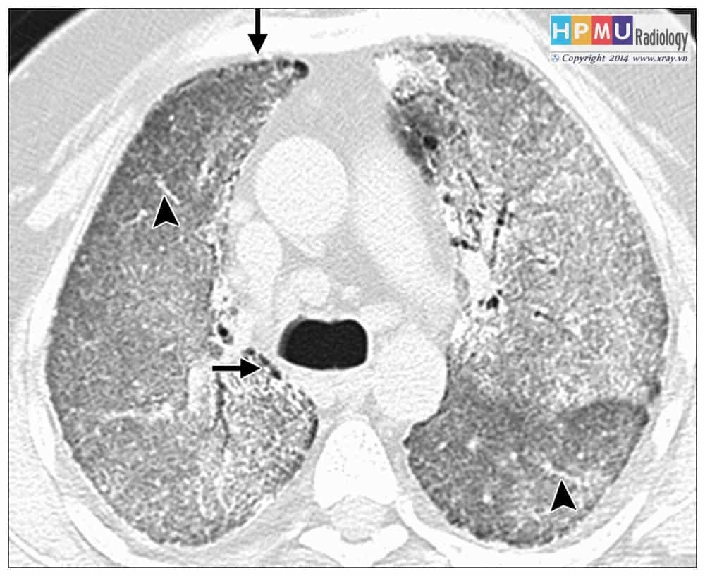 CT scan bệnh vi sỏi phế nang