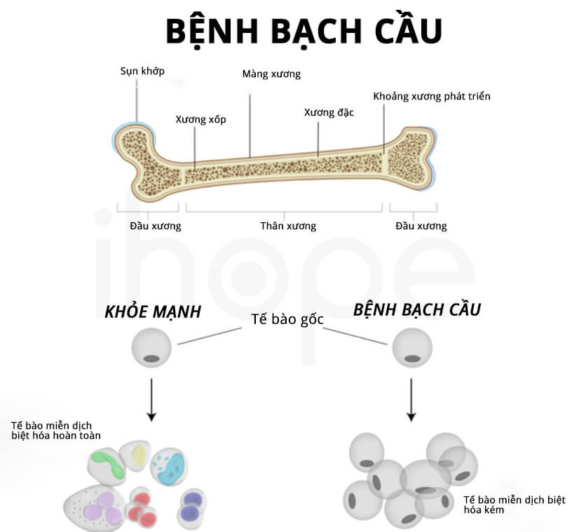 Mất bạch cầu hạt (Agranulocytosis): Hiểu đúng để không mất mạng 7 Phát triển bất thường của tế bào máu trong bệnh lý tủy