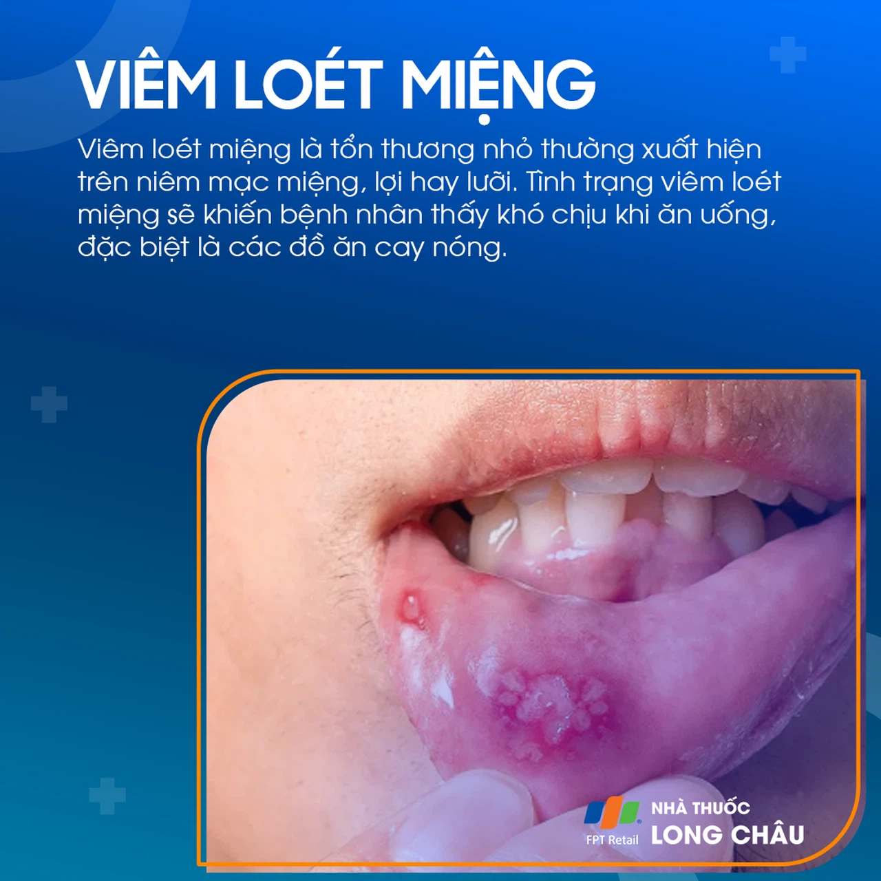 triệu chứng viêm loét miệng