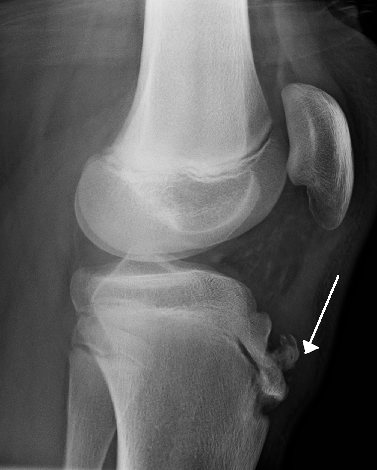 X-quang đầu gối bệnh nhân Osgood-Schlatter
