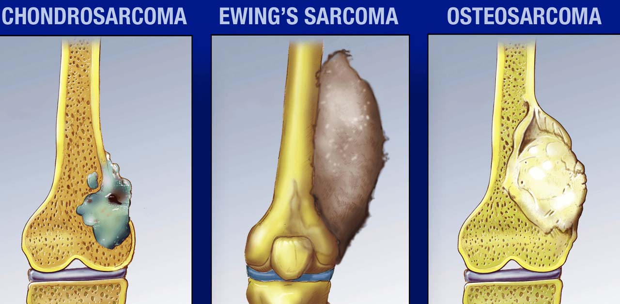 Hình ảnh sarcoma tạo xương ở trẻ em