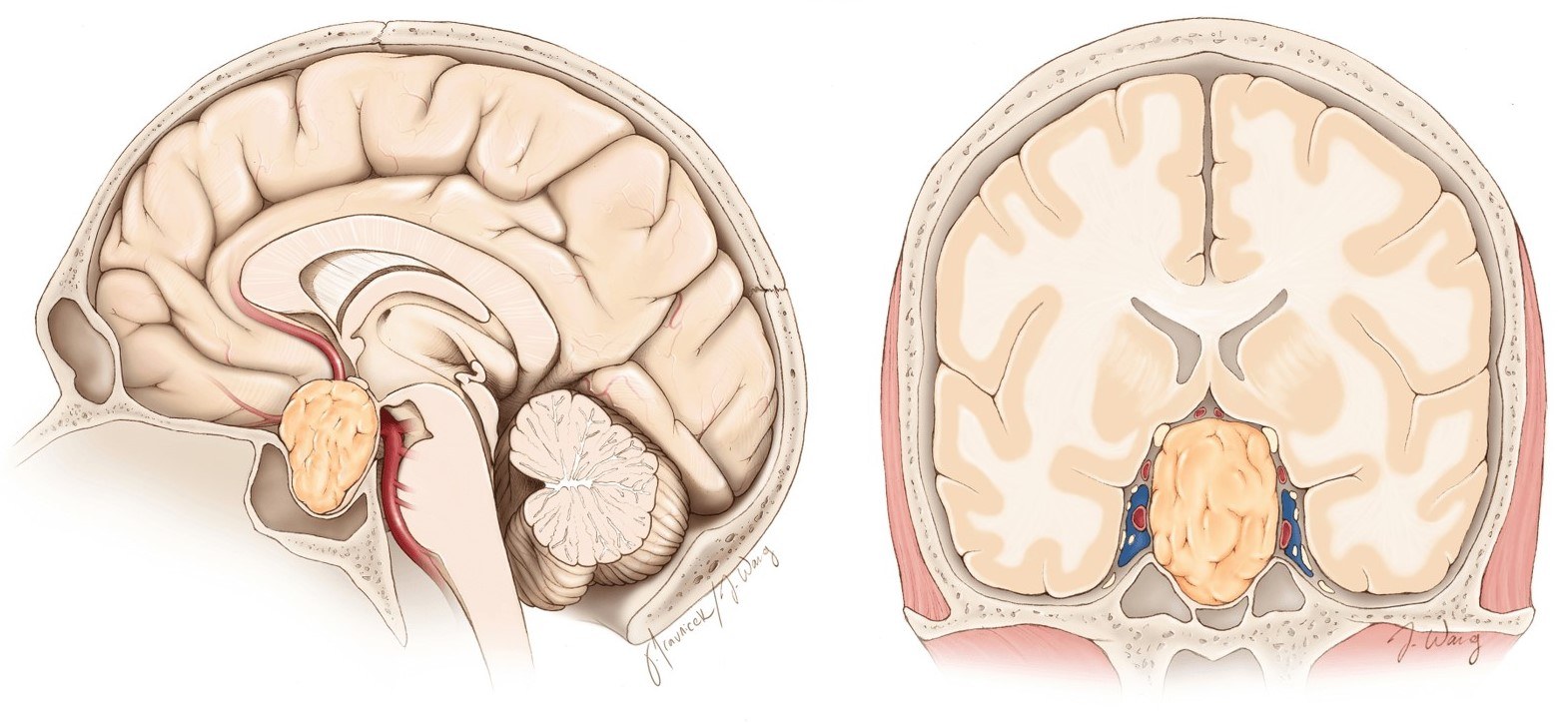 Hình ảnh siêu âm buồng trứng teo nhỏ do suy sớm