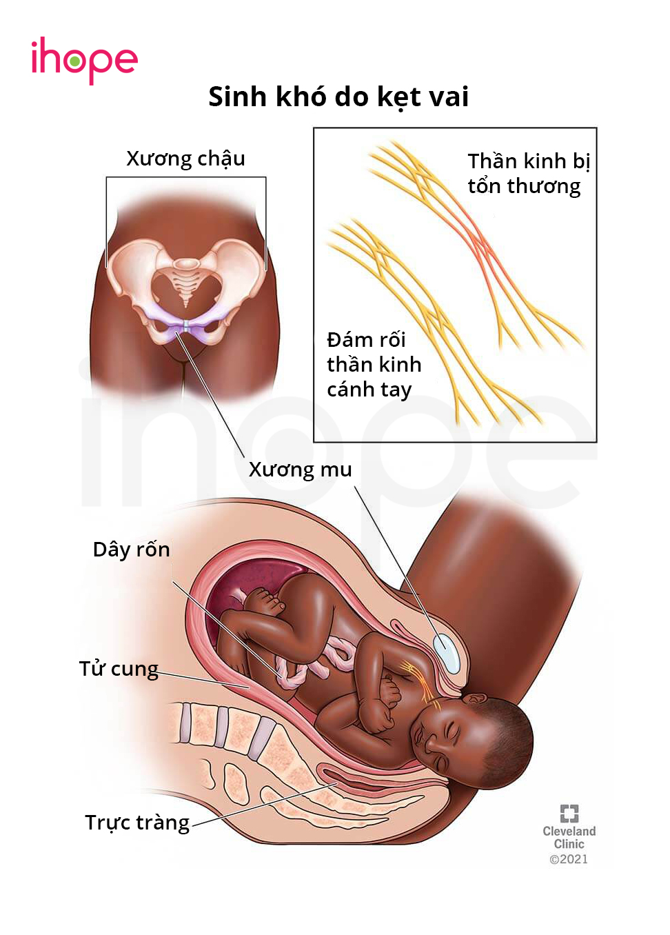 Kẹt vai khi sinh (Distoci do vai): Tình trạng nguy hiểm cần biết để bảo vệ mẹ và bé 7 Sinh khó do kẹt vai