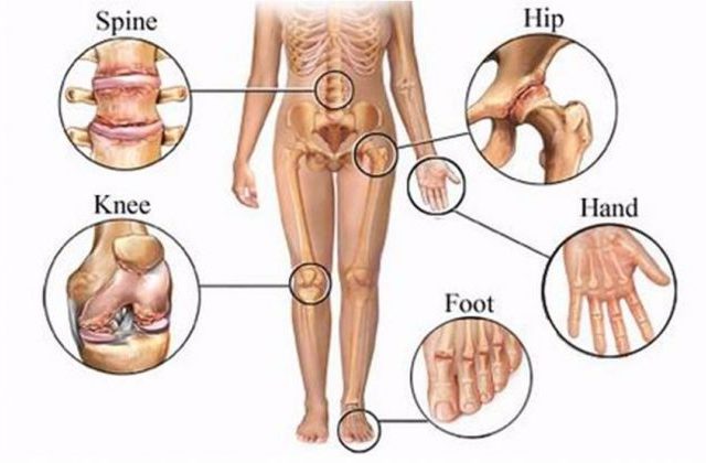 Thoái hóa đa khớp: Nguyên nhân, triệu chứng và cách điều trị hiệu quả 7 Thoái hóa đa khớp