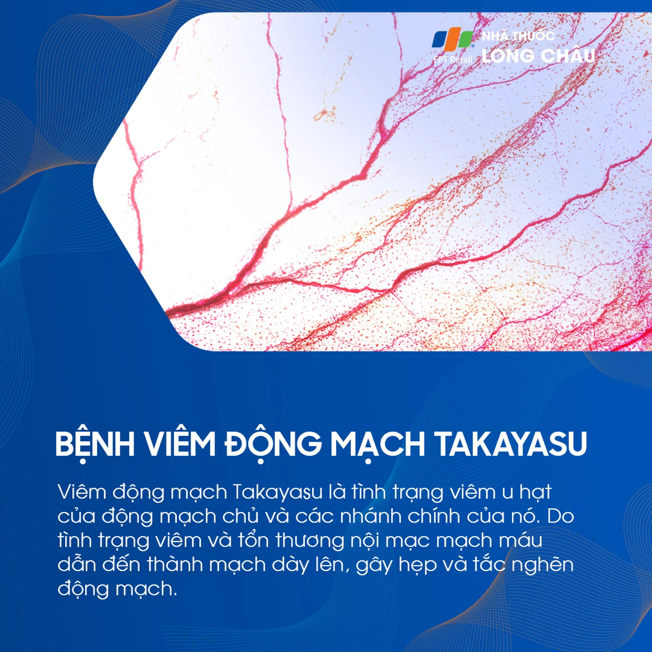 Viêm động mạch Takayasu ảnh minh họa