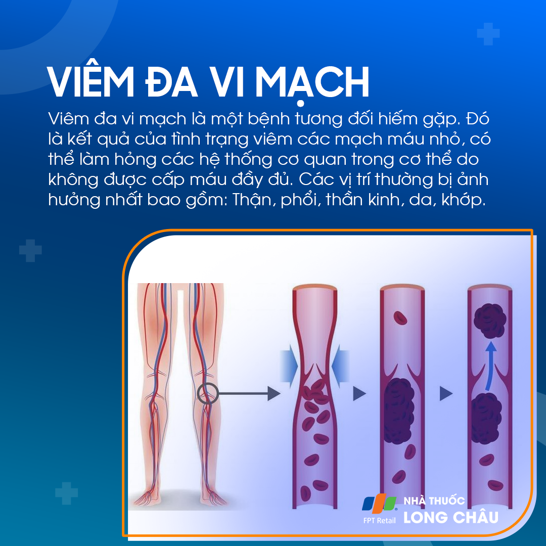 Hình ảnh mô phỏng viêm đa mạch vi thể