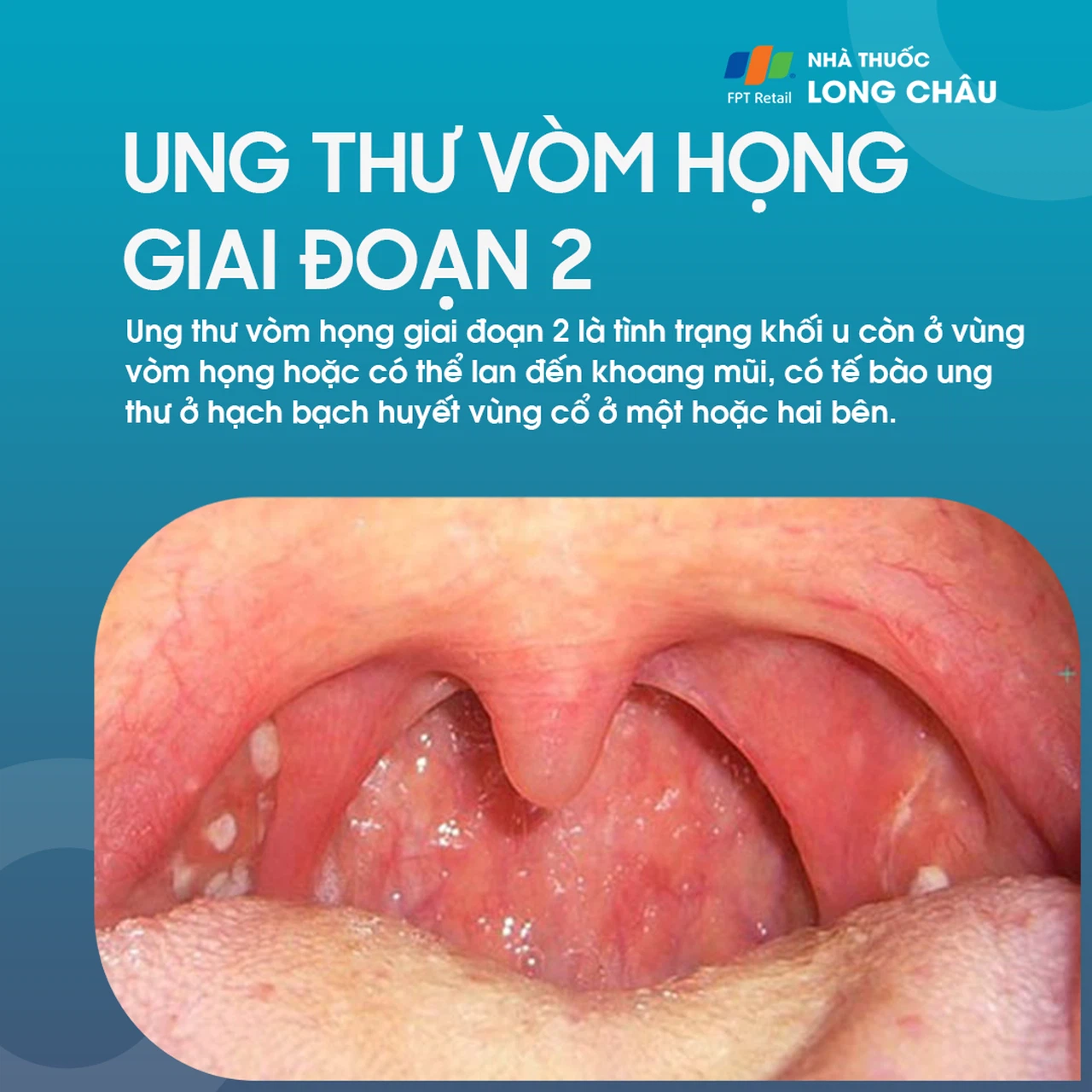 Triệu chứng ung thư vòm họng giai đoạn đầu