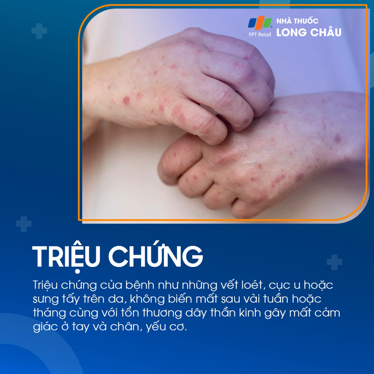 Tổn thương da do bệnh phong