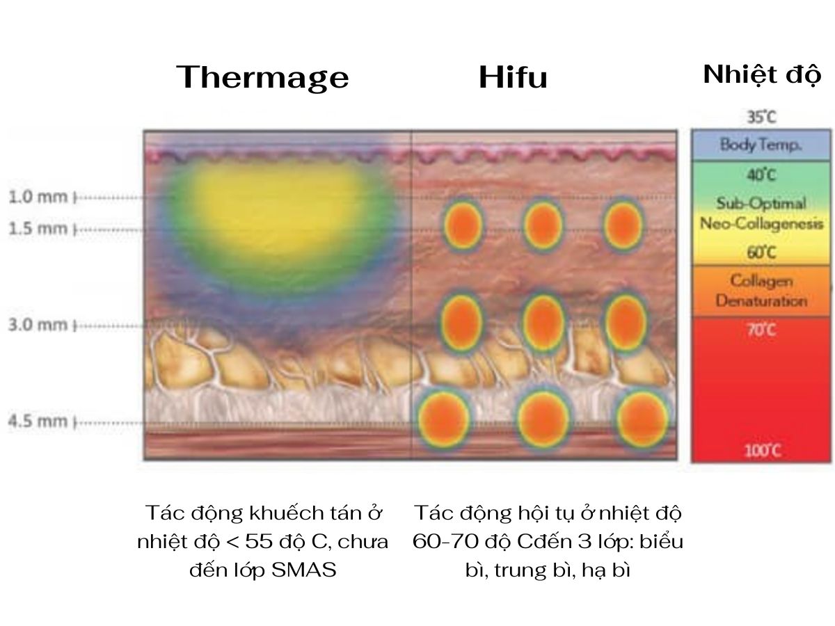 So sánh HIFU và Thermage