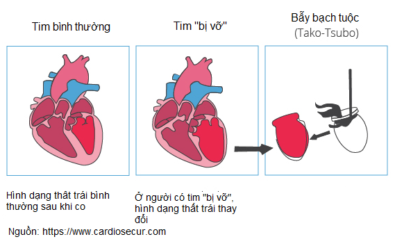 Hình ảnh minh họa hội chứng Takotsubo