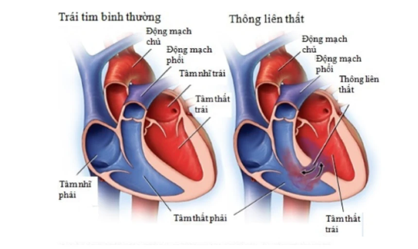 Thông liên thất (VSD): Dị tật tim bẩm sinh phổ biến ở trẻ nhỏ 8 siêu âm tim thông liên thất