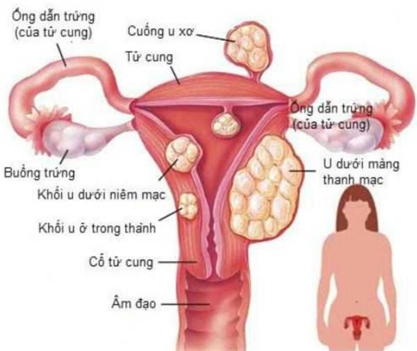 U xơ tuyến tiền liệt - nguyên nhân đi tiểu không hết bãi