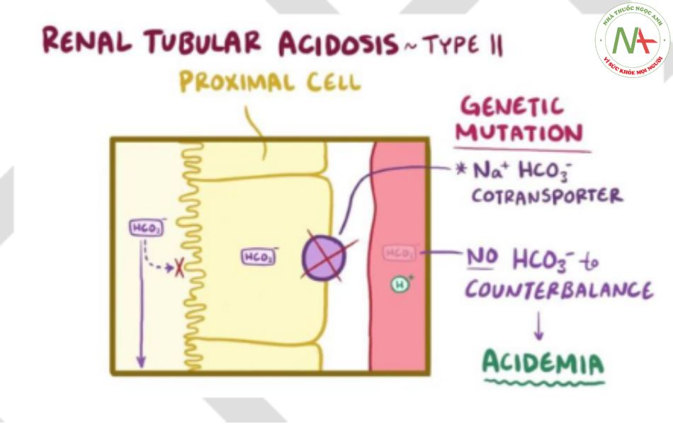 Nhiễm toan ống thận (Renal Tubular Acidosis): Nguyên nhân, dấu hiệu và cách điều trị hiệu quả 7 Nhiễm toan ống thận gần - Type II