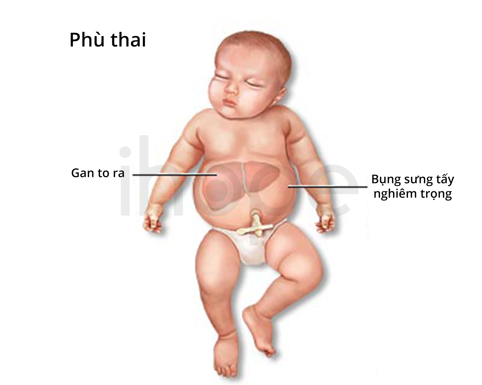 Hình ảnh thai nhi phù thai do Bart's hydrops fetalis