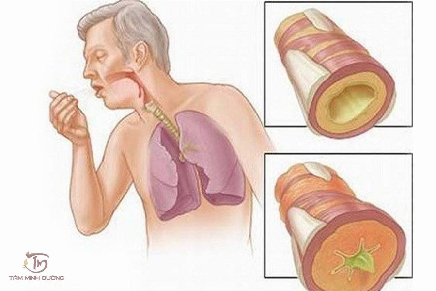 Ho có đờm: Nguyên nhân, triệu chứng và cách điều trị hiệu quả tại nhà 7 Triệu chứng ho có đờm