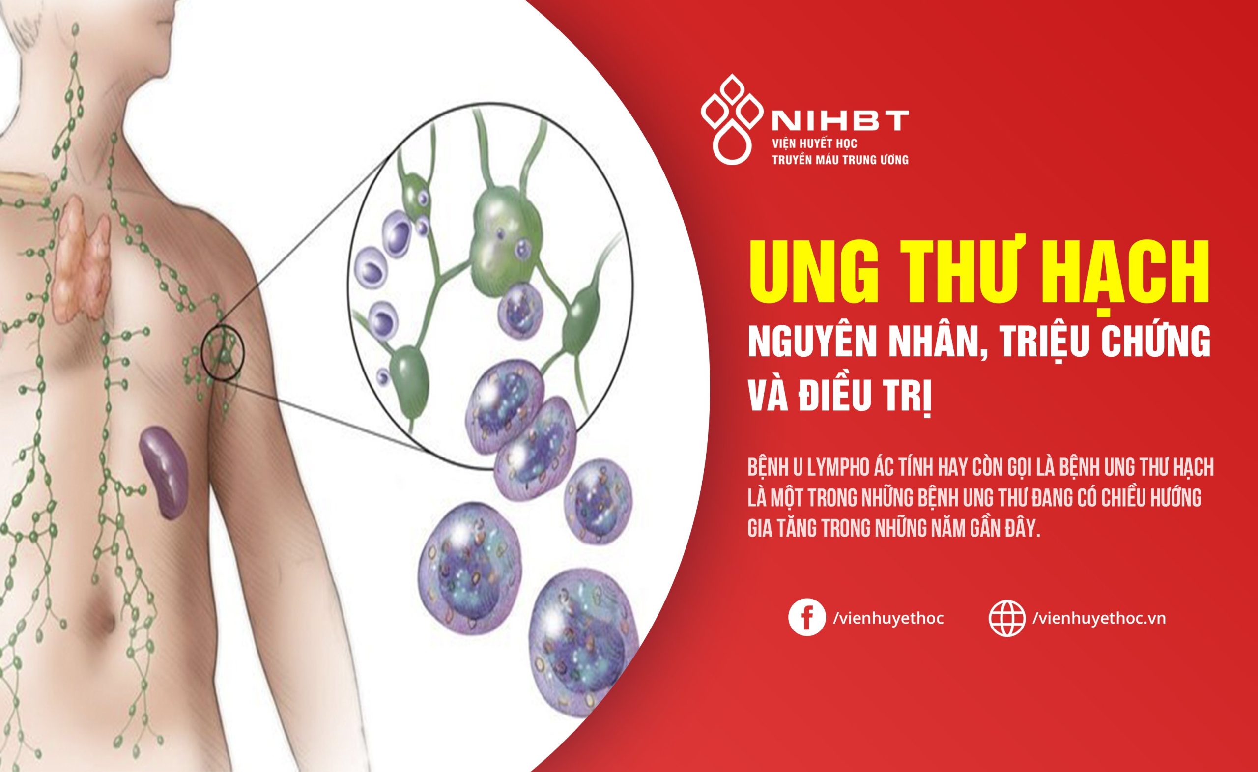 U lympho không Hodgkin là gì
