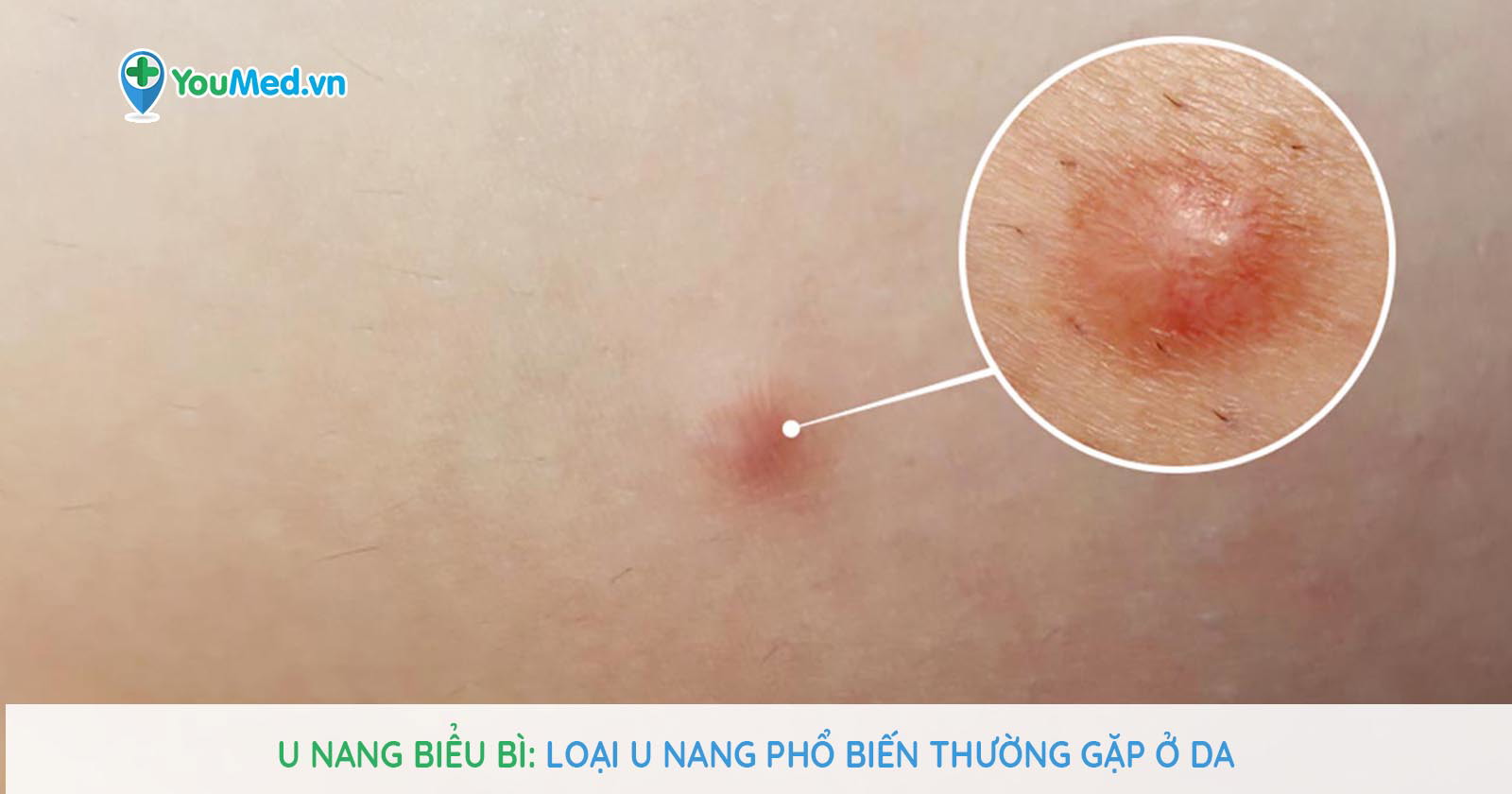 vị trí thường gặp u nang biểu bì