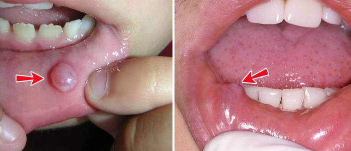 Hình ảnh u nang nhầy ở môi dưới