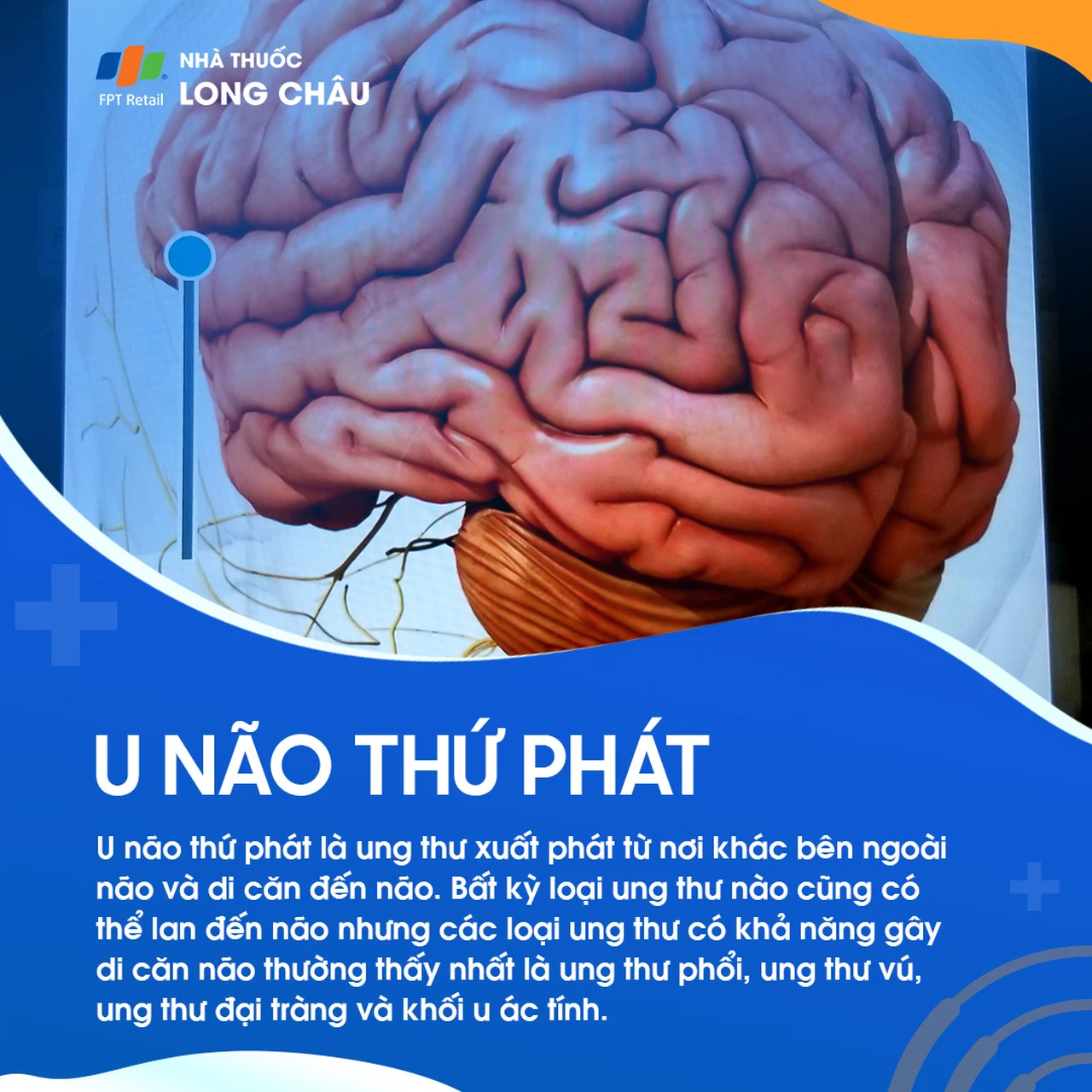 Triệu chứng u não thứ phát