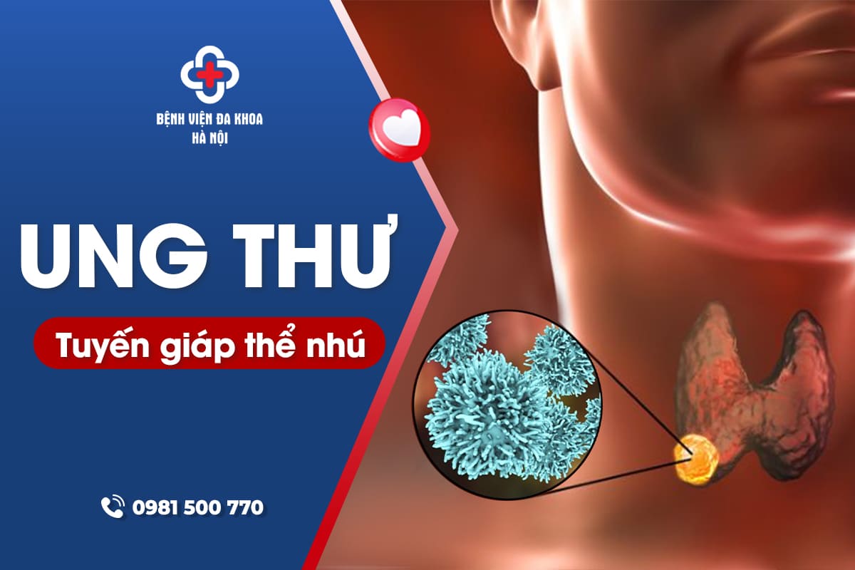 Ung thư tuyến giáp dạng nhú: Triệu chứng, nguyên nhân và cách điều trị hiệu quả 8 Ung thư tuyến giáp thể nhú