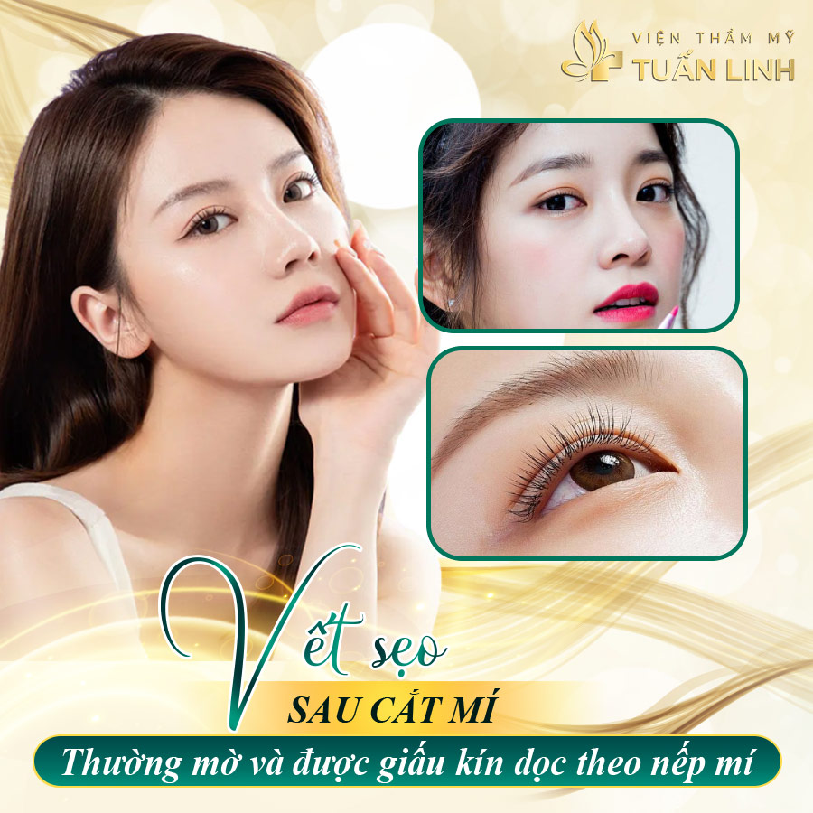 vết sẹo sau cắt mí