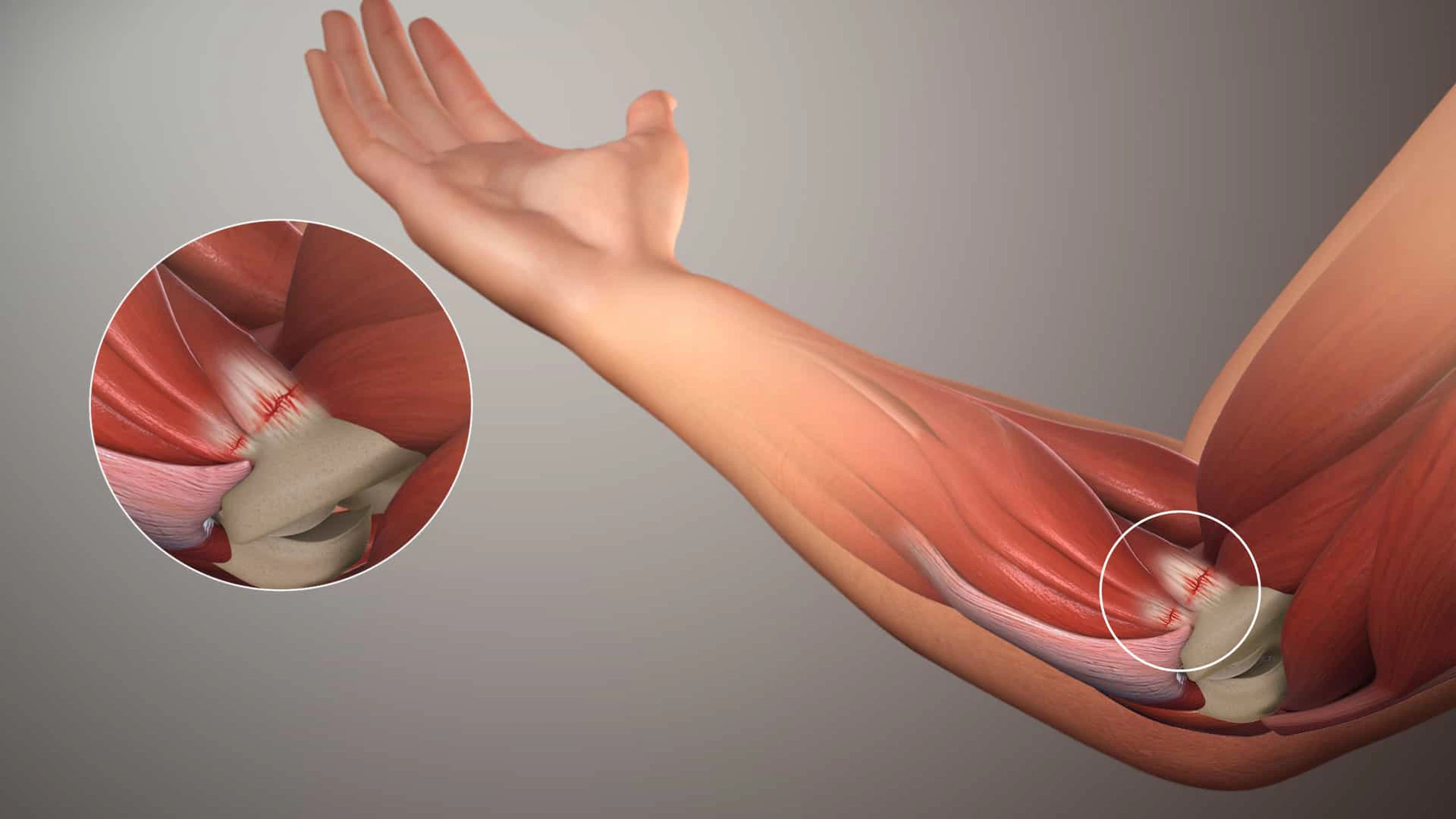 Viêm khớp khuỷu tay do thoái hóa