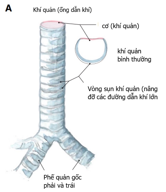 Nội soi khí quản thấy khí quản xẹp khi thở ra