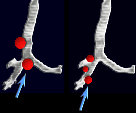 Hình ảnh nang phế quản qua CT scan