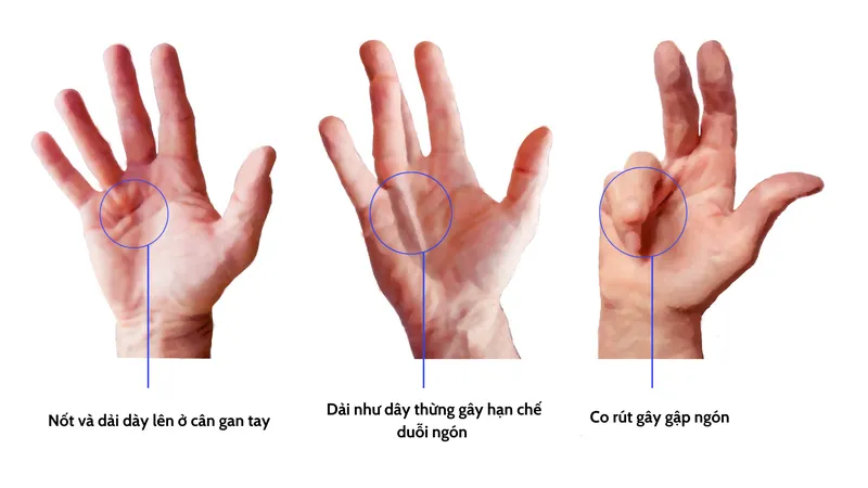 Cấu trúc gan tay bị co rút do Dupuytren