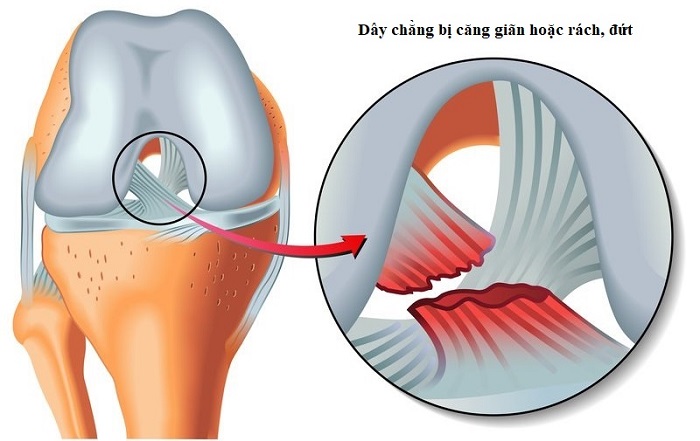 Chấn thương giãn dây chằng