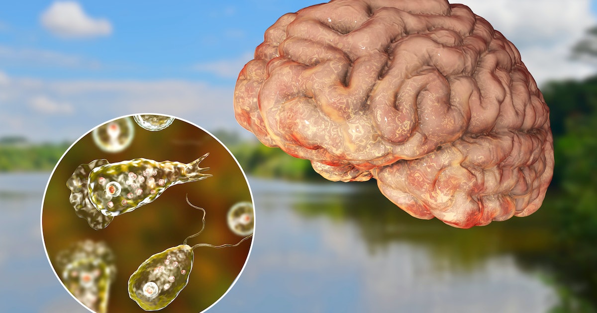 Viêm màng não - não do amip ăn não (Naegleria fowleri): Căn bệnh hiếm gặp nhưng cực kỳ nguy hiểm 8 Triệu chứng viêm não do amip