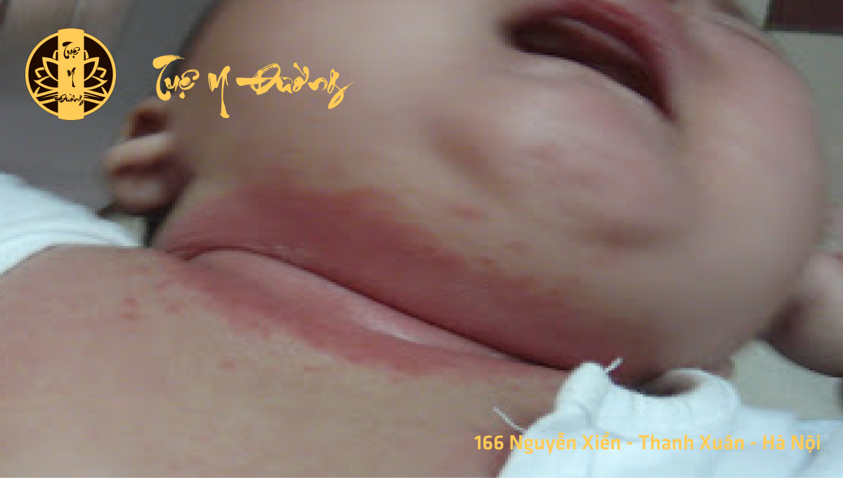 Viêm kẽ Candida hình ảnh thực tế