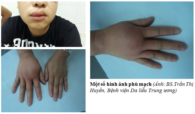 Hình ảnh phù mạch ở môi
