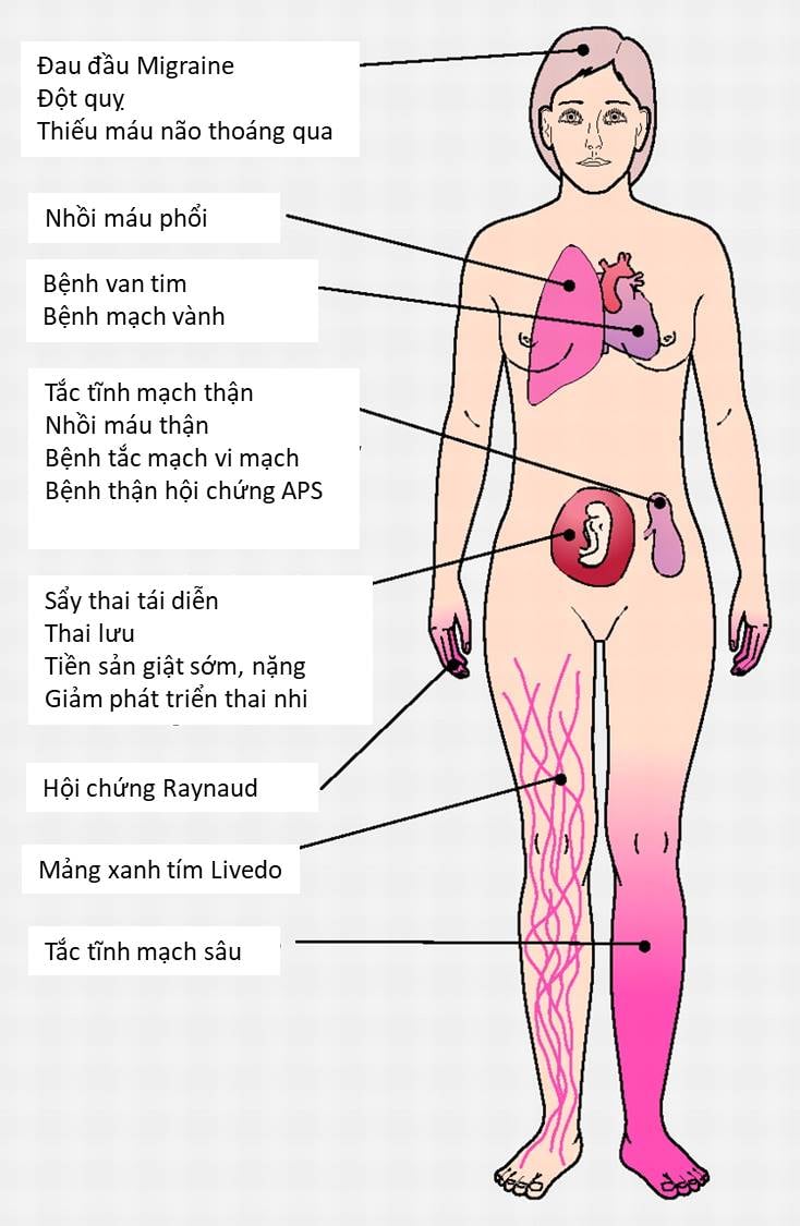 Hội chứng Antiphospholipid là gì