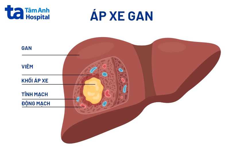 áp-xe gan là gì