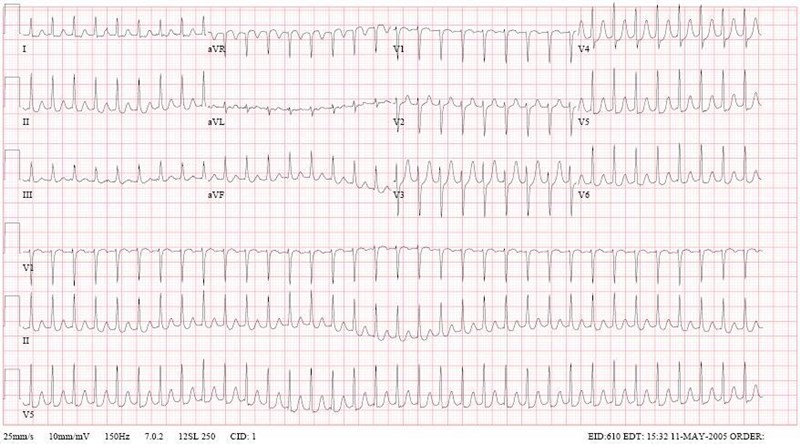 ECG ghi nhận nhịp nhanh trên thất