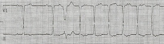ECG trong cơn AVNRT