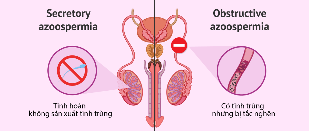 Phân biệt azoospermia tắc nghẽn và không tắc nghẽn