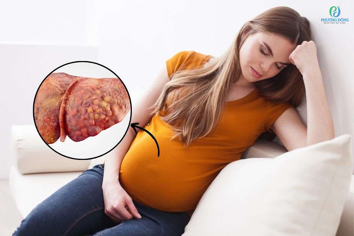 Triệu chứng gan nhiễm mỡ cấp tính thai kỳ