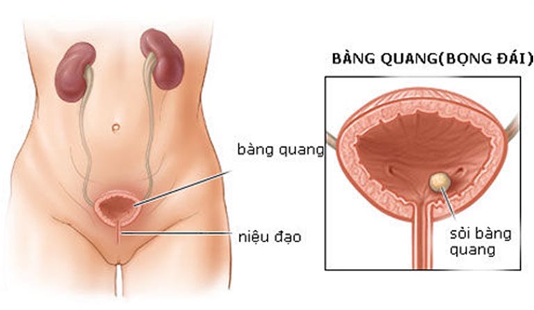 Hình ảnh bàng quang căng do bí tiểu
