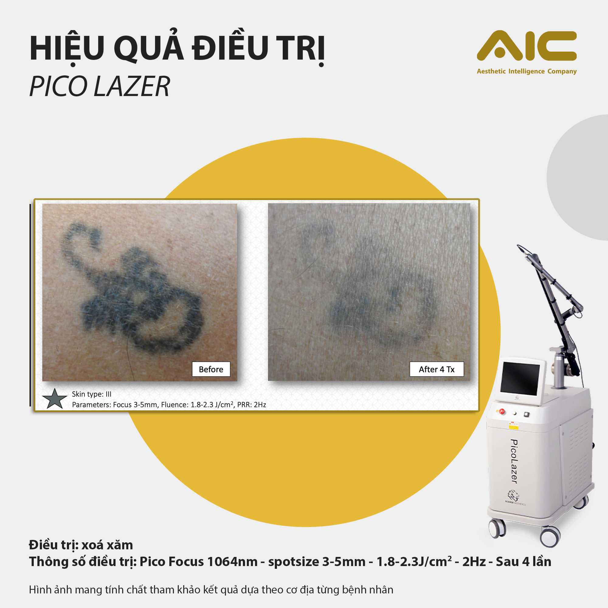 Trước và sau xóa xăm bằng laser Pico