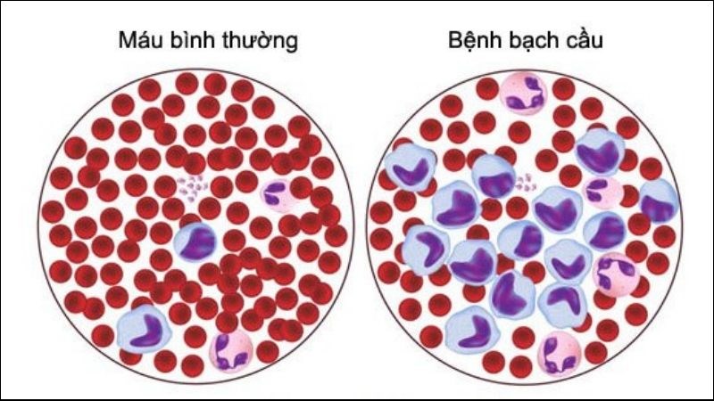 Bệnh bạch cầu dòng lympho mạn (CLL): Nguyên nhân, triệu chứng và hướng điều trị 7 Triệu chứng bệnh CLL